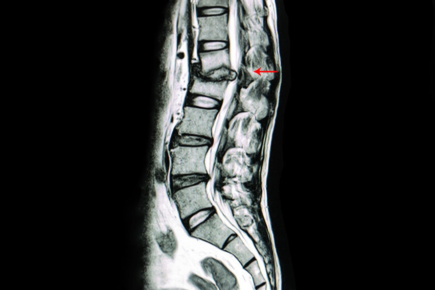 Application Spine Lumbar A Baker's Cyst